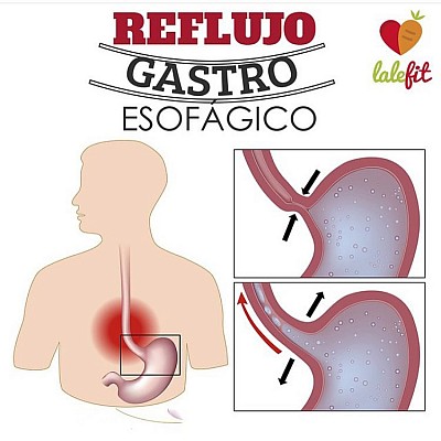 Reflujo gastro esofagico